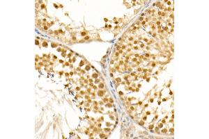 Immunohistochemistry of paraffin-embedded human breast cancer using CDK1 Rabbit mAb (ABIN7266576) at dilution of 1:100 (40x lens).