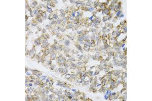 Immunohistochemistry of paraffin-embedded human esophageal cancer using ZAK antibody (ABIN5975284) at dilution of 1/100 (40x lens). (ZAK anticorps)