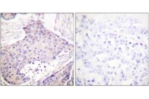 Immunohistochemistry analysis of paraffin-embedded human breast carcinoma tissue, using CARD6 Antibody.