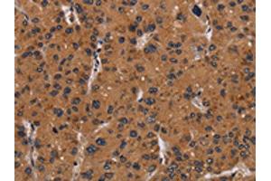 The image on the left is immunohistochemistry of paraffin-embedded Human liver cancer tissue using ABIN7191712(NRAS Antibody) at dilution 1/40, on the right is treated with synthetic peptide. (GTPase NRas anticorps)