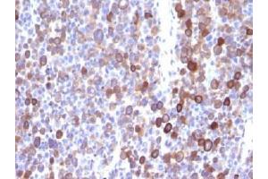 IHC testing of FFPE human melanoma with Moesin antibody (clone MSN/491).