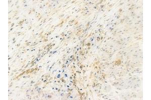 ABIN6257817 and ABIN6274533 at 1/100 staining human prostate carcinoma by IHC-P. (HMG20B anticorps  (N-Term))