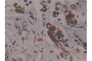 Detection of CS in Human Breast cancer Tissue using Polyclonal Antibody to Citrate Synthase (CS)