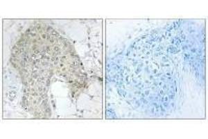 Immunohistochemistry analysis of paraffin-embedded human breast carcinoma tissue using PPP1R2 (Ab-120/121) antibody.