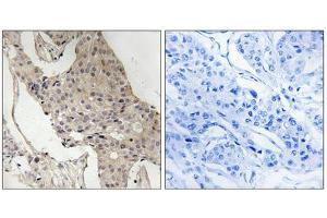 Immunohistochemistry analysis of paraffin-embedded human breast carcinoma tissue, using Gab2 (Phospho-Ser623) antibody.