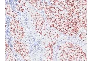 Formalin-fixed, paraffin-embedded human lung carcinoma stained with NKX2. (NKX2-1 anticorps)