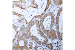 Immunohistochemical analysis of BCLX staining in human colon cancer formalin fixed paraffin embedded tissue section. (BCL2L1 anticorps  (Center))