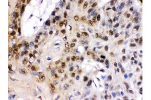 TCF7L1 was detected in paraffin-embedded sections of human oesophagus squama cancer tissues using rabbit anti- TCF7L1 Antigen Affinity purified polyclonal antibody at 1 μg/mL. (TCF7L1 anticorps  (C-Term))
