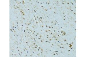 Immunohistochemistry of paraffin-embedded Human uterine cancer using NHEJ1 Polyclonal Antibody at dilution of 1:100 (40x lens).
