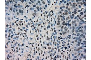 Immunohistochemical staining of paraffin-embedded Adenocarcinoma of breast tissue using anti-DHFR mouse monoclonal antibody. (Dihydrofolate Reductase anticorps)