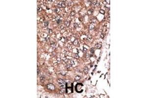 Formalin-fixed and paraffin-embedded human cancer tissue reacted with the primary antibody, which was peroxidase-conjugated to the secondary antibody, followed by AEC staining.