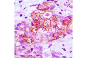 Immunohistochemical analysis of E Cadherin staining in human breast cancer formalin fixed paraffin embedded tissue section.