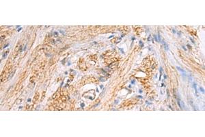 Immunohistochemistry of paraffin-embedded Human gastric cancer tissue using TMOD3 Polyclonal Antibody at dilution of 1:70(x200) (TMOD3 anticorps)