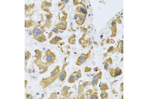 Immunohistochemistry of paraffin-embedded human liver cancer using BTD antibody at dilution of 1:100 (40x lens). (BTD anticorps)