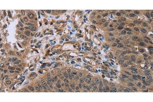 Immunohistochemistry of paraffin-embedded Human lung cancer using HOMER1 Polyclonal Antibody at dilution of 1:50 (HOMER1 anticorps)