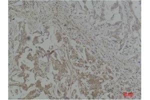 Immunohistochemistry (IHC) analysis of paraffin-embedded Human Breast Carcinoma using Stat1 Polyclonal Antibody.