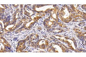 Detection of CK17 in Human Stomach cancer Tissue using Polyclonal Antibody to Cytokeratin 17 (CK17)