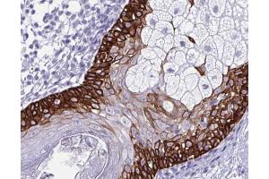 ABIN6266574 at 1/100 staining human colon cancer tissue by IHC-P. (Cytokeratin 5 anticorps  (C-Term))