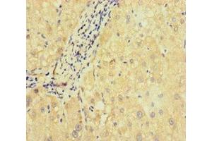 Immunohistochemistry of paraffin-embedded human liver cancer using ABIN7169972 at dilution of 1:100
