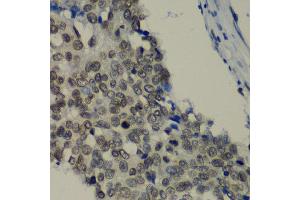 Immunohistochemistry of paraffin-embedded human lung cancer using TEAD1 antibody at dilution of 1:100 (x40 lens). (TEAD1 anticorps)