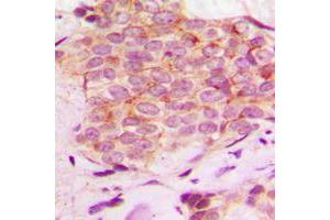 Immunohistochemical analysis of Mammaglobin A staining in human breast cancer formalin fixed paraffin embedded tissue section. (Mammaglobin A anticorps  (Center))