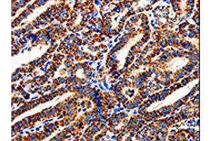 The image is immunohistochemistry of paraffin-embedded Human thyroid cancer tissue using ABIN7129012(COX19 Antibody) at dilution 1/50. (COX19 anticorps)