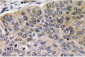 Immunohistochemistry (IHC) analyzes of Cathepsin E antibody in paraffin-embedded human lung carcinoma tissue. (Cathepsin E anticorps)