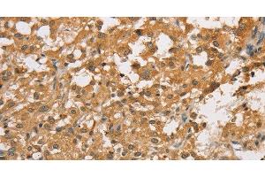Immunohistochemistry of paraffin-embedded Human thyroid cancer using ARHGEF5 Polyclonal Antibody at dilution of 1:50 (ARHGEF5 anticorps)