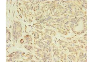 Immunohistochemistry of paraffin-embedded human breast cancer using ABIN7163630 at dilution of 1:100 (PDGFRB anticorps  (AA 901-1106))