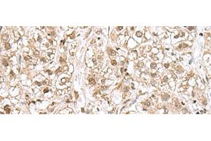 Immunohistochemistry of paraffin-embedded Human liver cancer tissue using RPL35 Polyclonal Antibody at dilution of 1:70(x200) (RPL35 anticorps)