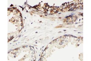 Anti-Kallikrein 11 antibody, IHC(P) IHC(P): Human Prostatic Cancer Tissue (Kallikrein 11 anticorps  (C-Term))
