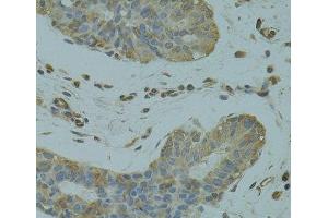 Immunohistochemistry of paraffin-embedded Human breast cancer using DGKQ Polyclonal Antibody at dilution of 1:100 (40x lens). (DGKQ anticorps)
