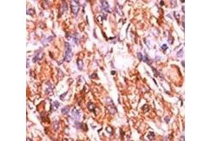 IHC analysis of FFPE human hepatocarcinoma tissue stained with the p-Rb1 antibody. (Retinoblastoma Protein (Rb) anticorps  (pSer811))