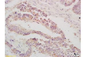 Formalin-fixed and paraffin embedded human colon carcinoma labeled with Anti-ATF3 Polyclonal Antibody, Unconjugated (ABIN669561) at 1:200 followed by conjugation to the secondary antibody and DAB staining (ATF3 anticorps  (AA 51-150))