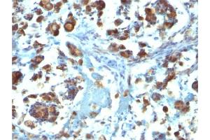 Formalin-fixed, paraffin-embedded human Gastric Carcinoma stained with MUC3 Mouse Monoclonal Antibody (M3.