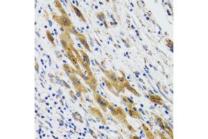 Immunohistochemistry of paraffin-embedded human liver cancer using PLA2G2D antibody (ABIN5974036) at dilution of 1/100 (40x lens). (PLA2G2D anticorps)