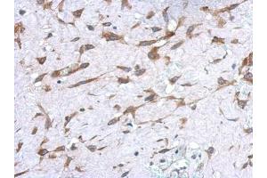 IHC-P Image Immunohistochemical analysis of paraffin-embedded human hepatoma, using UGT1A, antibody at 1:500 dilution. (Ugt1 anticorps)