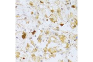 Immunohistochemistry of paraffin-embedded human brain astrocytoma using FCN1 Antibody (ABIN2562567) at dilution of 1:100 (40x lens).