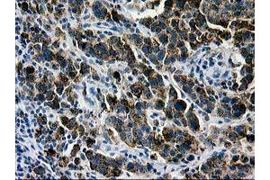 Immunohistochemical staining of paraffin-embedded Carcinoma of Human lung tissue using anti-LGALS3BP mouse monoclonal antibody. (LGALS3BP anticorps  (AA 19-300))