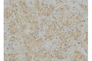 ABIN6272934 at 1/100 staining Human breast cancer tissue by IHC-P. (STING/TMEM173 anticorps  (Internal Region))