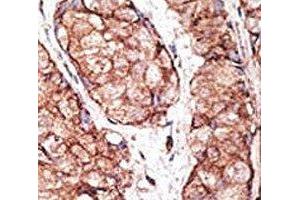 IHC analysis of FFPE human breast carcinoma tissue stained with the TLR5 antibody