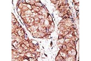 IHC analysis of FFPE human breast carcinoma tissue stained with the TLR5 antibody (TLR5 anticorps  (AA 71-102))