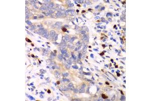 Immunohistochemistry of paraffin-embedded human gastric cancer using S100A12 antibody (ABIN6291358) at dilution of 1:100 (40x lens).