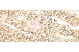 Immunohistochemistry of paraffin-embedded Human gastric cancer tissue using DMC1 Polyclonal Antibody at dilution of 1:30(x200)