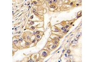 IHC analysis of FFPE human lung carcinoma tissue stained with EPHB2 antibody