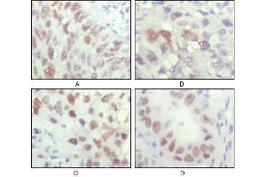 Immunohistochemical analysis of paraffin-embedded human lung carcinoma (A), liver carcinoma (B), breast carcinoma (C) and kiney carcinoma (D), showing nuclear localization with DAB staining using CHK2 antibody. (CHEK2 anticorps  (AA 481-531))