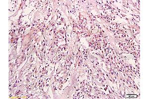 Formalin-fixed and paraffin embedded: human endometrium tissue labeled with Anti-KRAS Polyclonal Antibody (ABIN736671), Unconjugated at 1:200, followed by conjugation to the secondary antibody and DAB staining