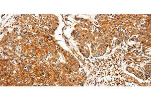 Immunohistochemistry of paraffin-embedded Human esophagus cancer using TPM2 Polyclonal Antibody at dilution of 1:30 (TPM2 anticorps)