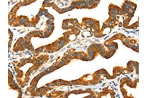 The image on the left is immunohistochemistry of paraffin-embedded Human thyroid cancer tissue using ABIN7192030(PRSS50 Antibody) at dilution 1/30, on the right is treated with synthetic peptide. (MASP1 anticorps)