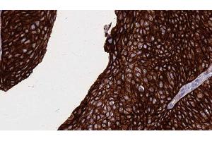 ABIN6268889 at 1/100 staining Human urothelial cancer tissue by IHC-P.